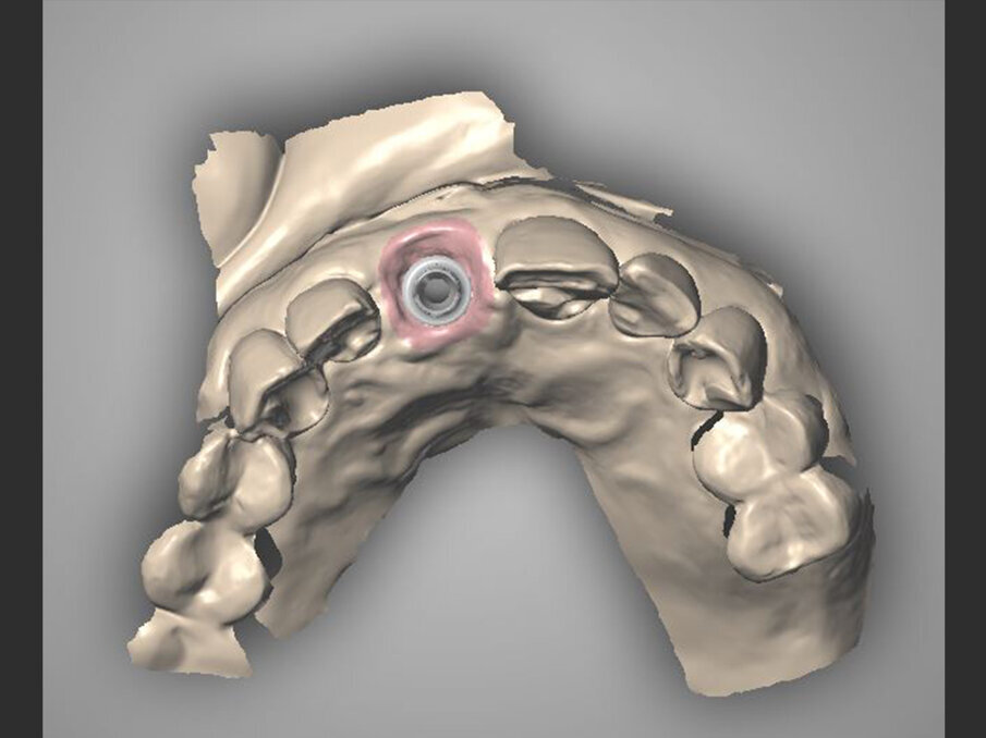 Figg. 9a, 9b - Acquisizione intraorale: tragitto transmucoso in visione occlusale.