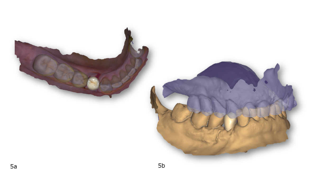 Figs. 5a & b: CAD modelling in DentalCAD of the definitive restoration. Photorealistic rendering (a). Aligned master and antagonist models (b).