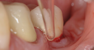 L’ozonoterapia nella gestione della Perimplantite: case report