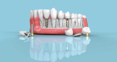 Dentsply Sirona обявява цялостно възобновяване на бизнеса си с импланти