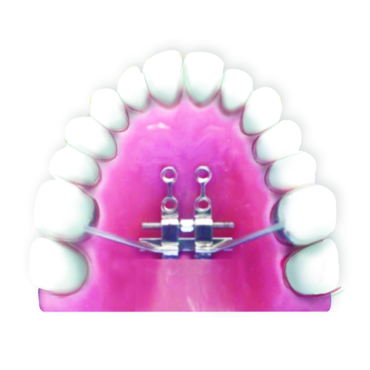 Fig.5 Bone- tooth anchored design: 4 anterior TADs and support of molars