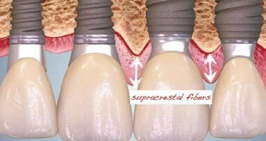 Modified clinical approach for improved aesthetics in full-arch restoration
