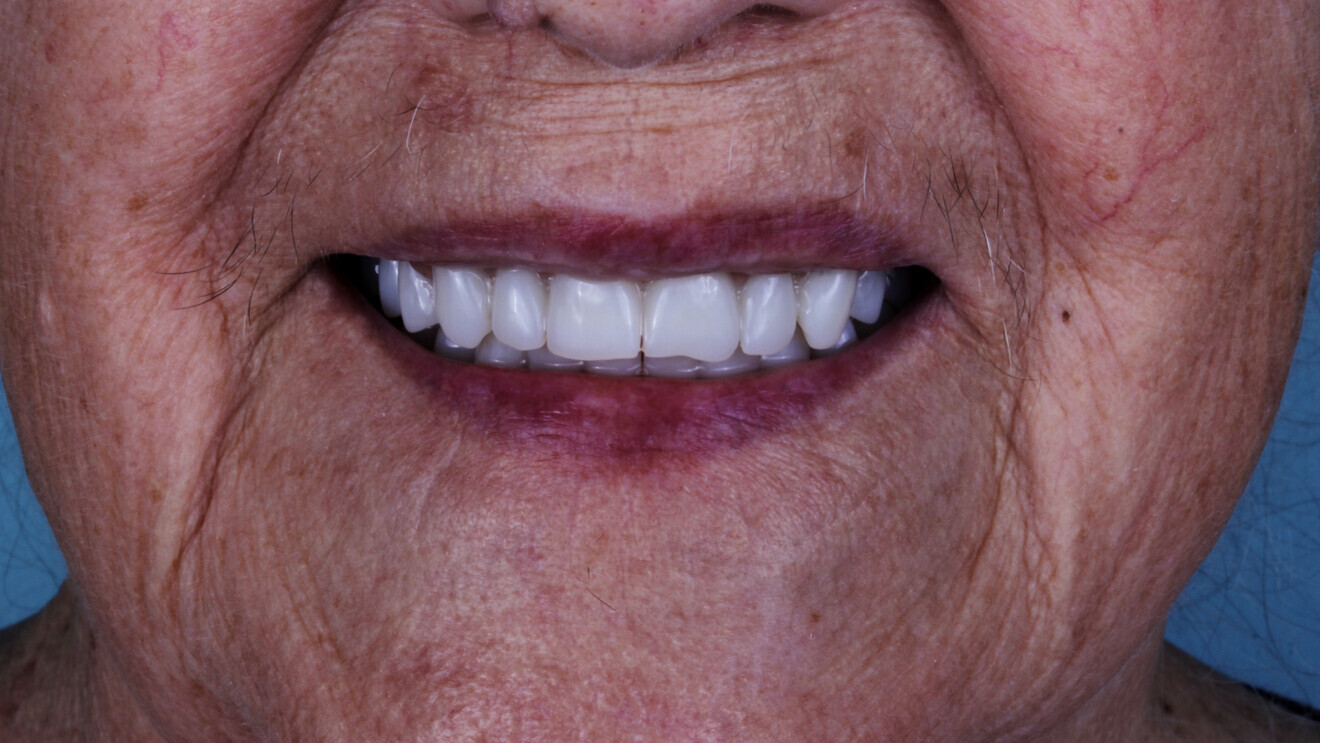 Fig. 12 : Photographie du sourire avec la prothèse d’usage imprimée en 3D.