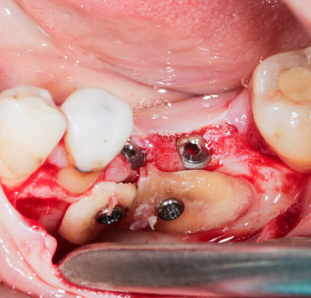 Fig. 6: The roots were shaped to fit the defect and fixated at the insertion site using osteosynthesis screws.