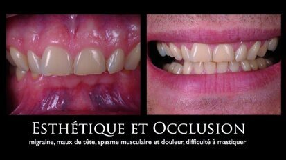 Dentisterie adhésive totale : tout est dans l'équilibre occlusal