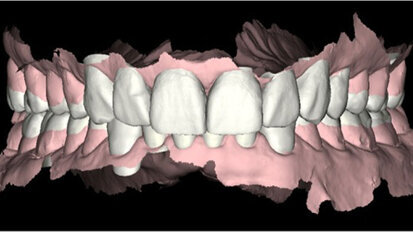 Fig. 3. Escaneado intraoral inicial con Carestream 3500.