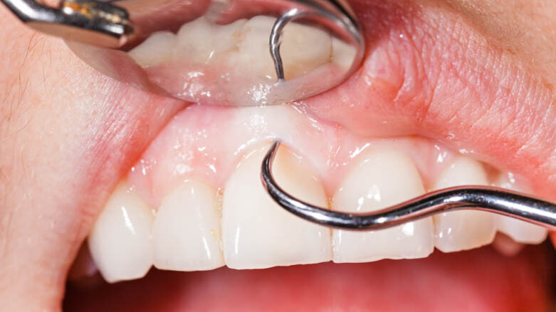 Free oral cancer screenings to be offered throughout parts of Australia