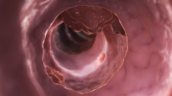 Une bactérie orale peut contribuer au cancer colorectal