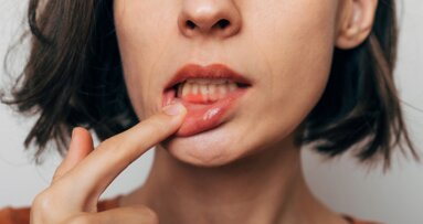 Global periodontitis burden rises sharply despite stable rates, data shows