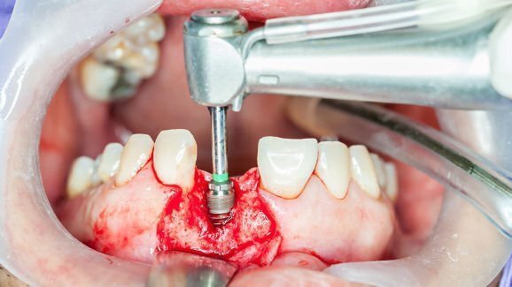 Dental implants market in China to grow at a CAGR of 28.26 per cent