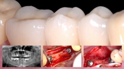 Rehabilitación inmediata con implantes y ROG horizontal