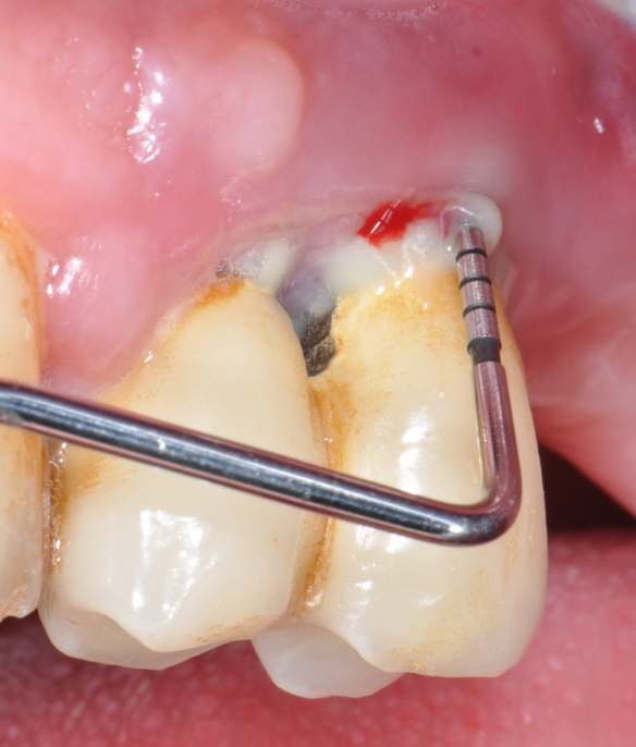 Fig.12: Case 2. Baseline. Probing reveals a deep PPD with abundant suppuration and BOP.