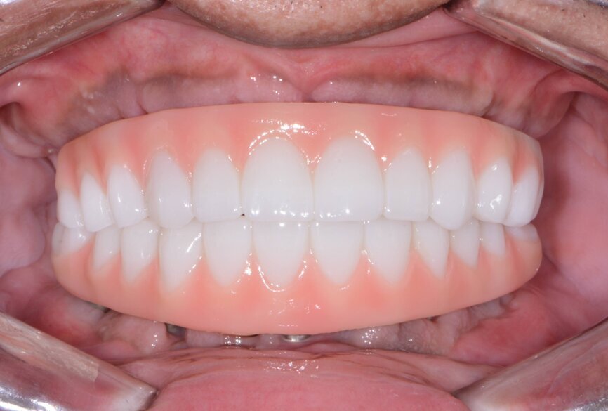19: Maxillary and mandibular fixed provisional restorations.