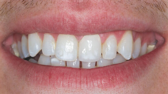 Central details: Smile renewed with esthetic Obsidian crown