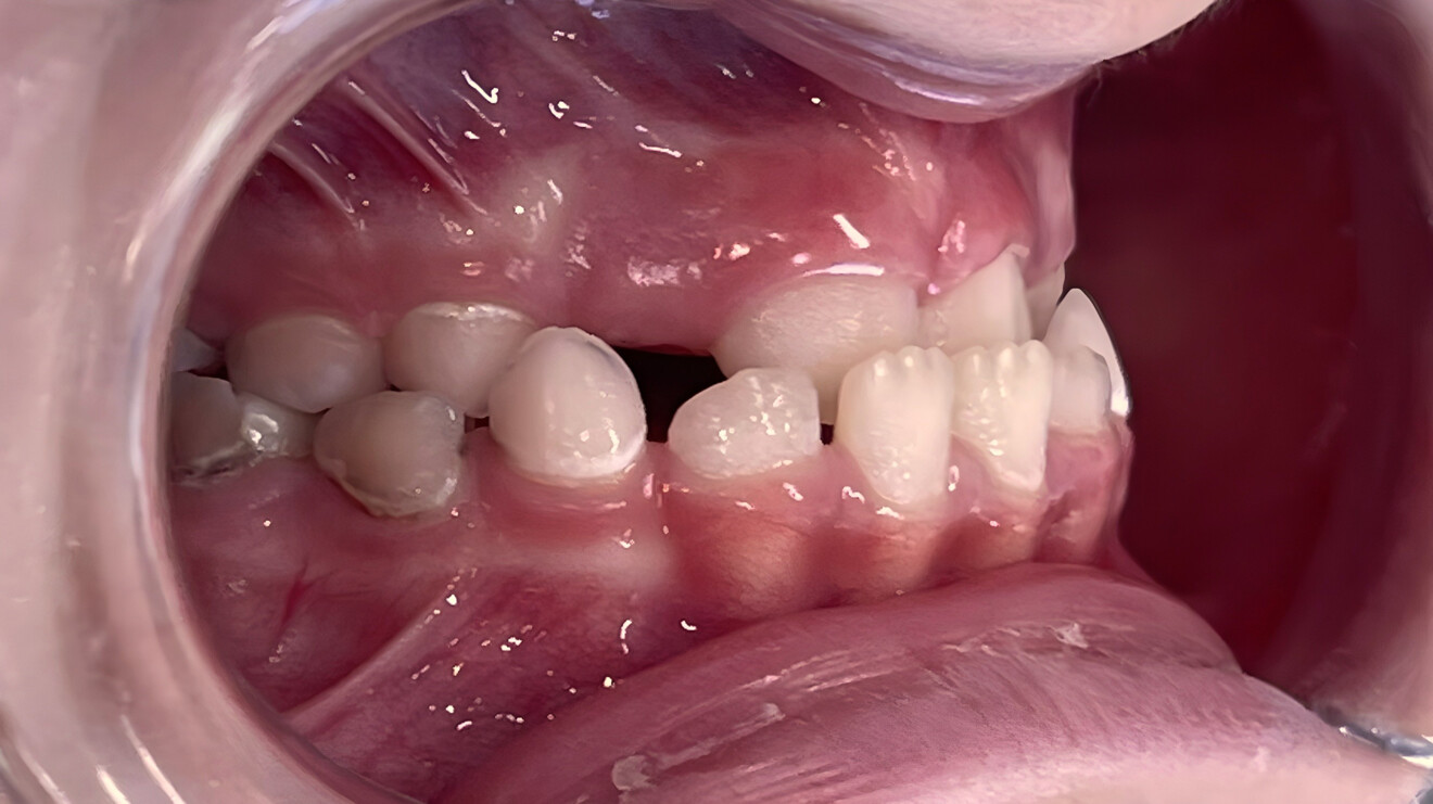  Figs. 1d–h: Pre-treatment records. Intra-oral photographs.