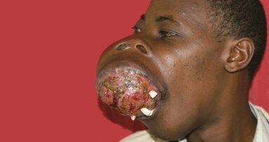 Plastic surgeons remove large jaw tumours