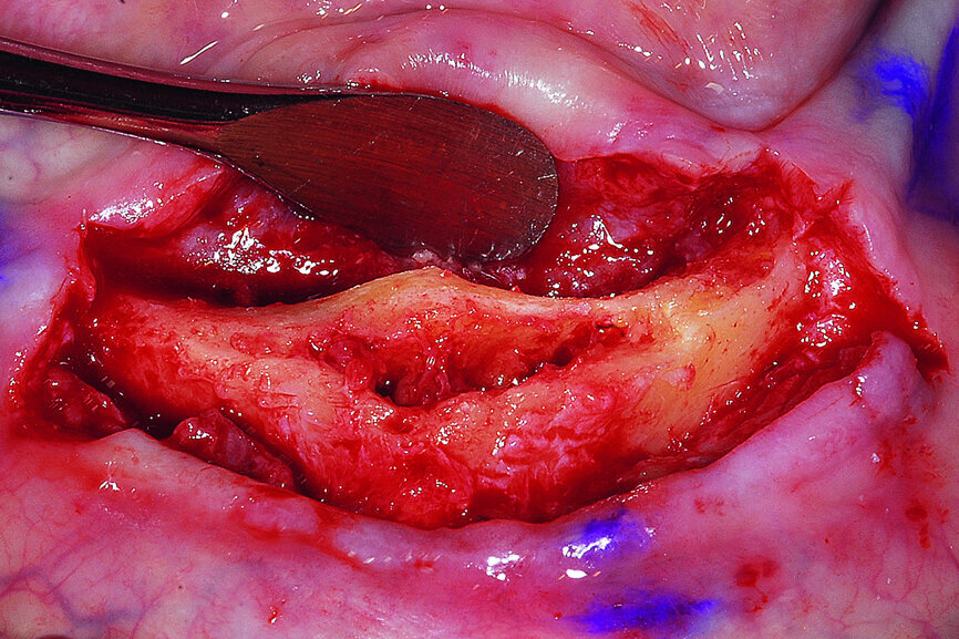 Fig. 15: The anterior symphysis revealing the anterior ‘hollow’ symphysis.