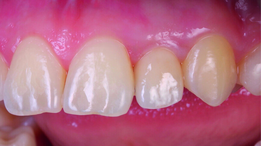 Fig. 22: Final outcome after the completion of the treatment.
