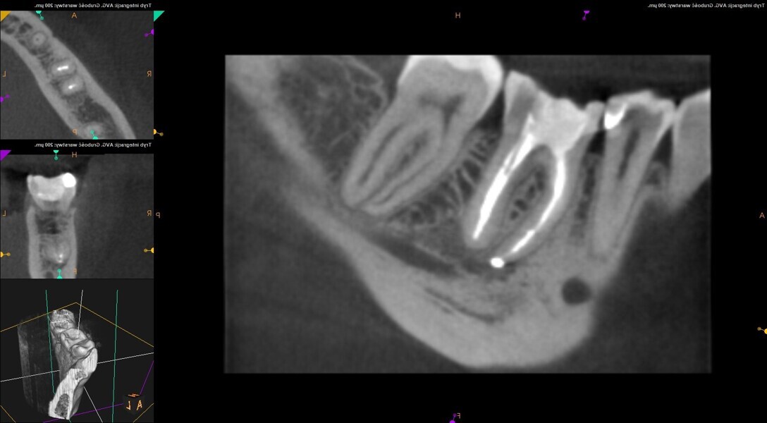 Fig. 24: CBCT scan at the six-month follow-up.