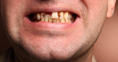 Dentists fear DIY tooth extractions as Wales hikes NHS fees