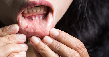 Artificial intelligence used to predict oral cancer survival chances