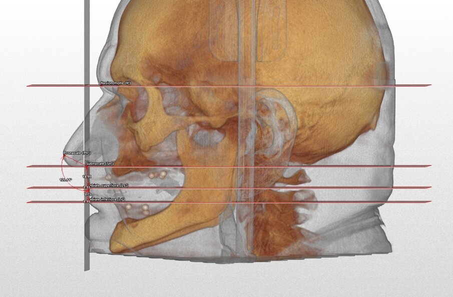Fig. 6_Correlazione tra la posizione dell’asse incisale anteriore e il supporto labiale.