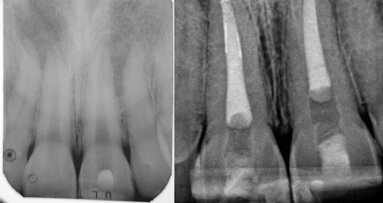Irrigating the root canal: A case report