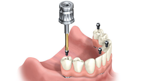 Response to Dental Tribune International article, ‘Study suggests dentists cause implant failure’