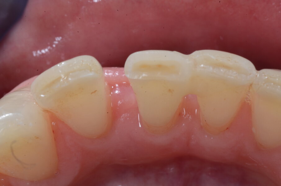 Figg. 6k-6m - Guarigione ad 1 mese.