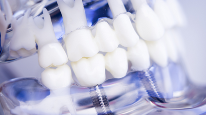 Bessere Osseointegration: Beschichtete Implantate entwickelt