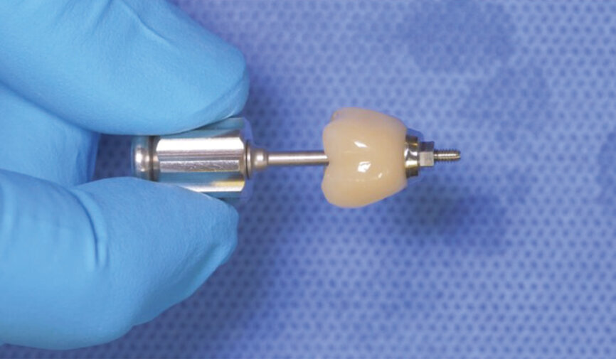 Fig. 15: Clean and polish the restoration prior to seating. Surfaces that will come into contact with soft tissue should be polished. 