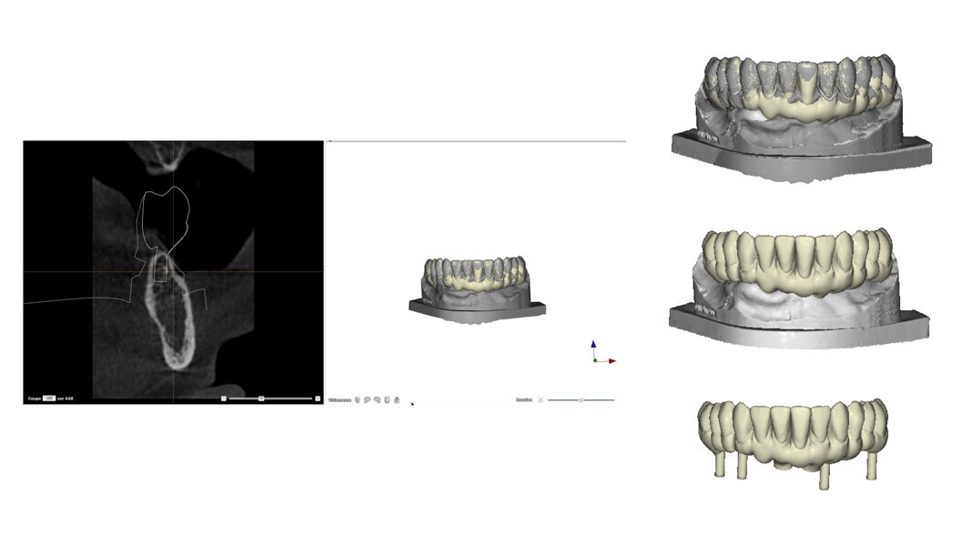 Fig. 7: Design of the prosthesis.