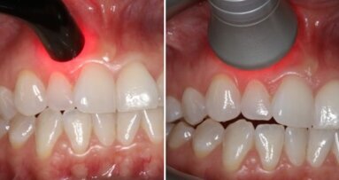 Fotobiomodulacja jako narzędzie wspomagające gojenie ran po leczeniu chirurgicznym