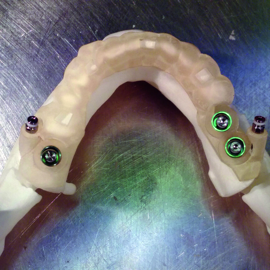 Fig. 3: A model with the guide and implants after the implantation. The guide was stabilised with two posts.