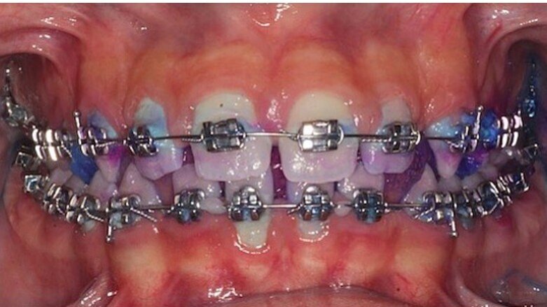 La terapia proattiva nel mantenimento del paziente ortodontico parodontale