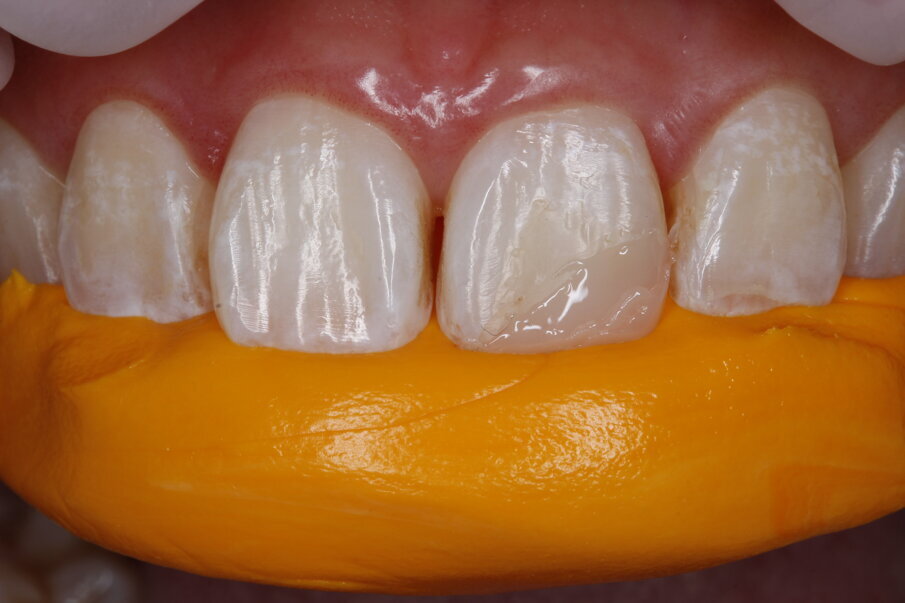Fig 4: Putty index created with impression material