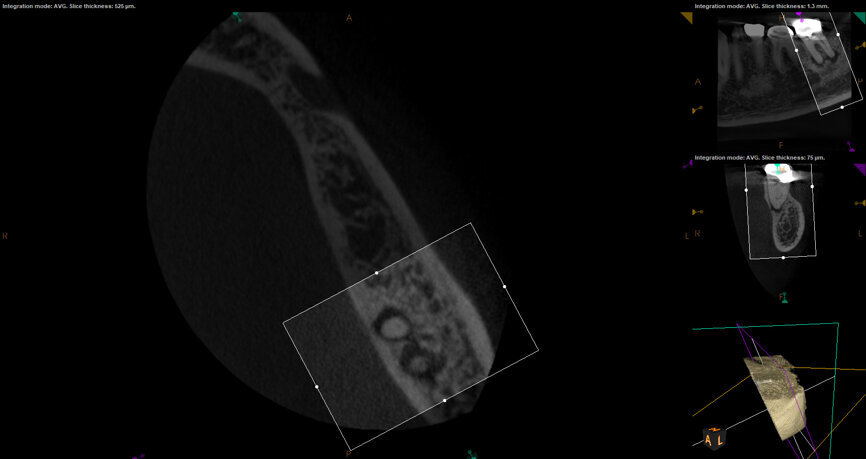 Fig. 17e: Case assisted with CBCT to determine anatomy pre-operatively. Note the multiple cross sections moving apically and the correlation to the 2-D view. Note also the conservative taper in relation to the root width. (Courtesy of Dr. Brett Gilbert)