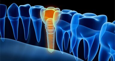 Computer-aided, template-guided immediate implant placement and loading in the mandible