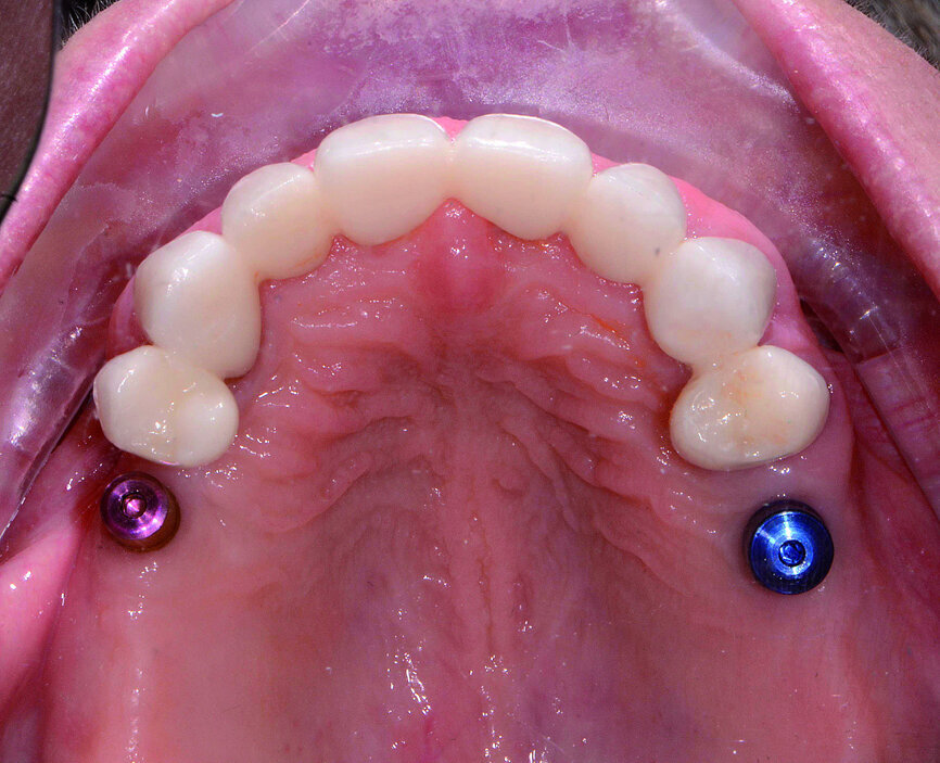 Fig. 12: Extended healing caps on implants creating an emergence
profile.