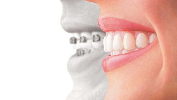 El desplazamiento dental ¿Ciencia de la salud o cosmética peligrosa?