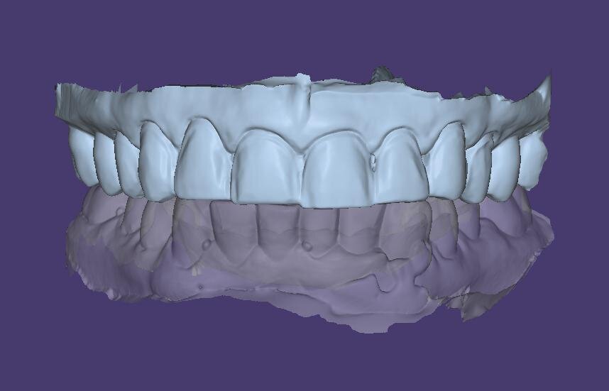 Fig. 6: Maxillary and mandibular models aligned in occlusion.