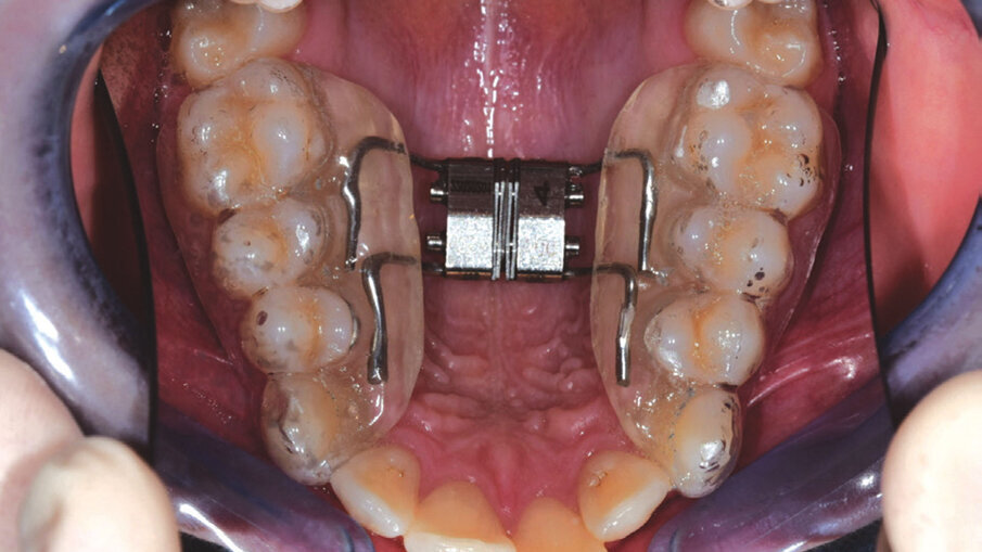 Figg. 2a-2c_Utilizzo del dispositivo ALLEO+ come ausiliare per espandere e ottenere spazio in arcata superiore, al fine di utilizzare, successivamente, un numero di allineatori ridotto e una minore quantità di stripping.