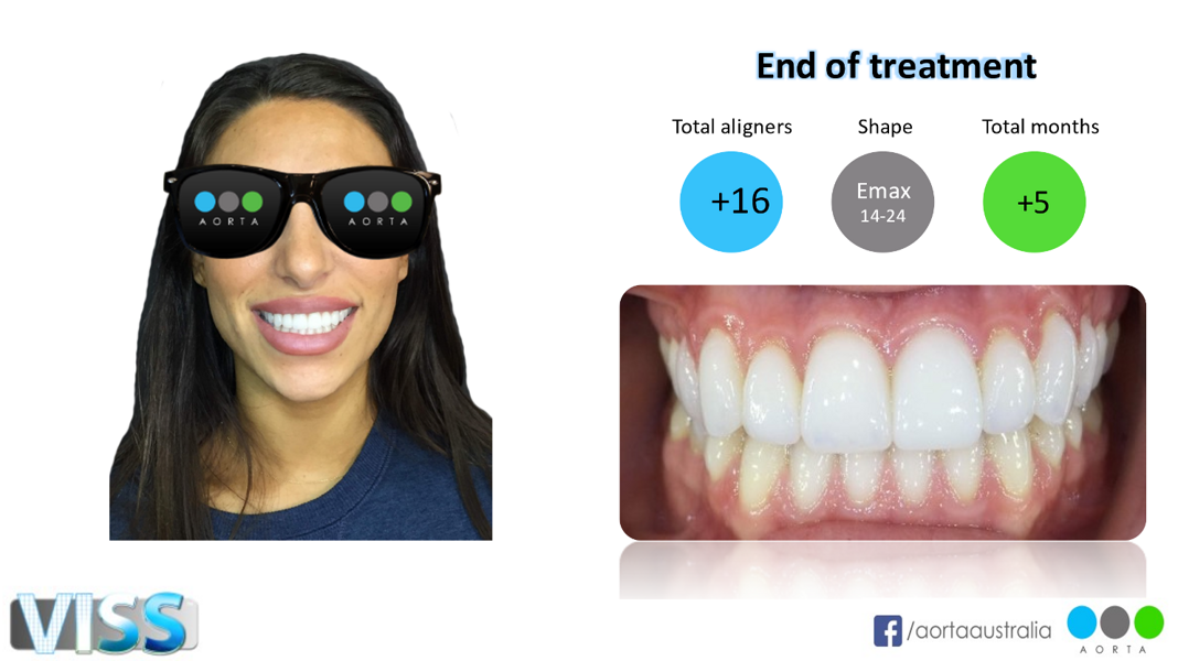 Fig. 46: The result after veneers, soft-tissue recontouring and whitening.
