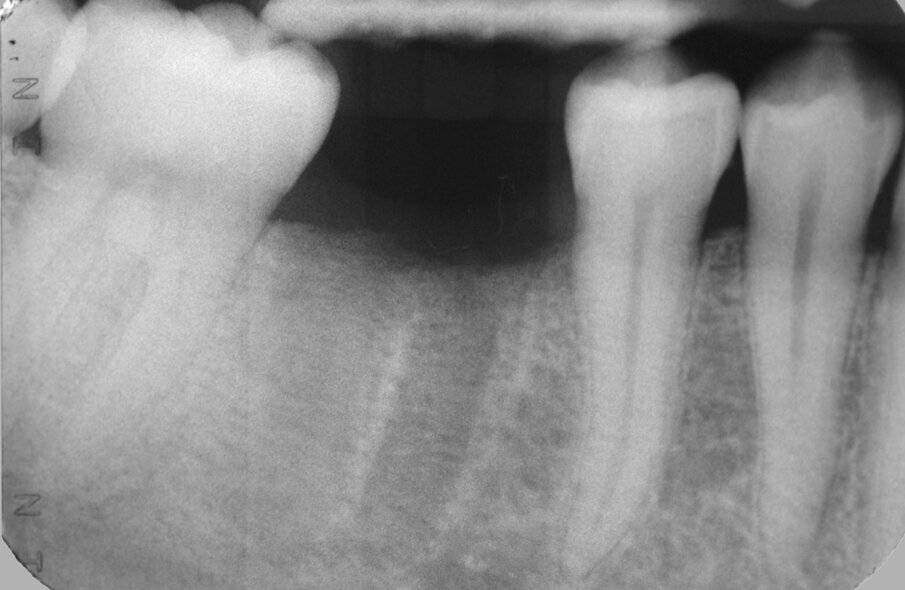 Fig. 5: After eight weeks, the amount of bone formation into the
socket allowed for implant placement.