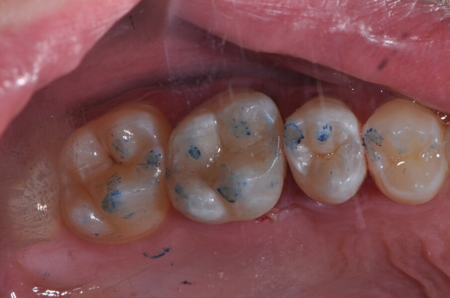 Fig. 7 - Foto intraoperatoria del restauro diretto finalizzato e controllo occlusale.