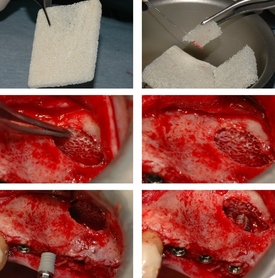 Fig. 5_Posizionamento di un blocco di osso spongioso di origine equina al di sotto della membrana sinusale: dopo avere ricavato un blocco di dimensioni adeguate, ed averlo idratato con soluzione fisiologica, lo stesso è posizionato all’interno della cavità. Si inseriscono il secondo e terzo impianto. L’apice dell’impianto in posizione 2.7 appoggia sul blocco osseo e non entra in contatto con la membrana sinusale. 
