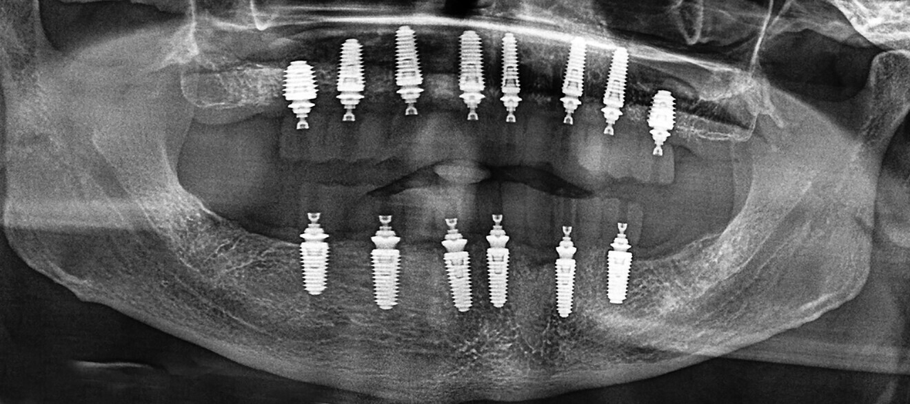 Fig. 12c: Using extracted teeth to achieve autologous bone substitute using the Smart Dentin Grinder.