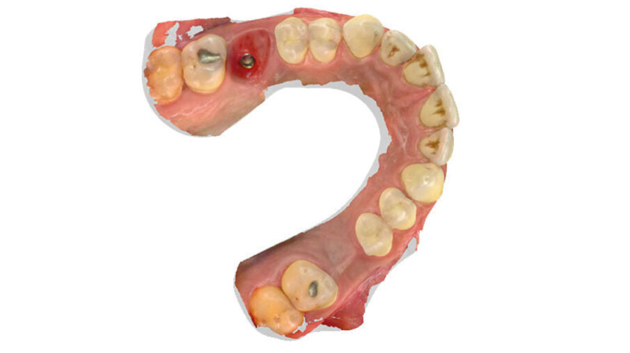 Fig. 10 - Scansione definitiva del tunnel transmucoso.