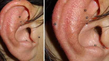 Auricoloterapia ed odontoiatria: nuove sinergie per l’odontoiatria olistica