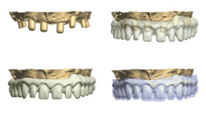 The use of CBCT and CAD/CAM techniques in implant-supported rehabilitation of maxilla—Part II